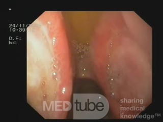 Les deux ulcères du bulbe duodénal - "kissing ulcers".