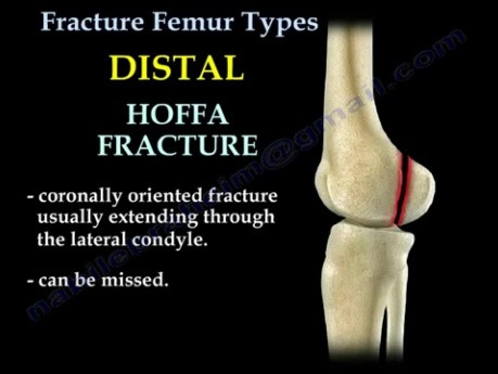 Types de fracture du fémur