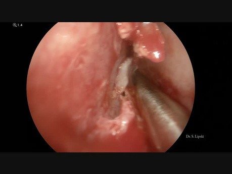 Septoplastie endoscopique, turbinoplastie et traitement d'une sinusite unilatérale