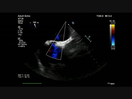 Foramen ovale perméable avec shunt gauche-droit