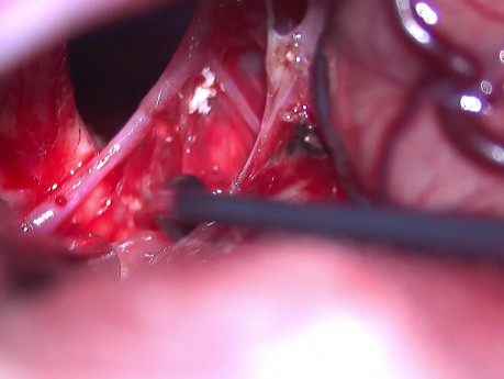 Résection d'un craniopharyngiome géant