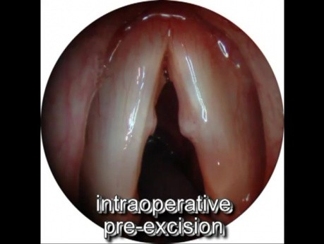 Nodules des Cordes Vocales - Microchirurgie