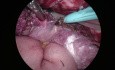Comment Eviter les Lésions Intestinales pendant la Chirurgie vNOTES