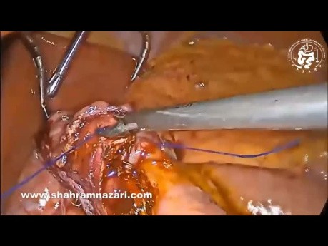 Conversion Laparoscopique de la Sleeve Gastrectomy en Mini Bypass Gastrique