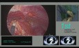 Thymomectomie et thymectomie étendue sous-xiphoïde selon la méthode CTVA / VATS uniportale.