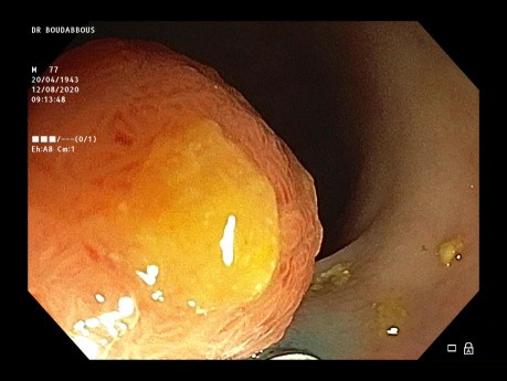 La mucosectomie endoscopique (EMR) multifragmentaire de la tumeur sigmoïde LST-G.