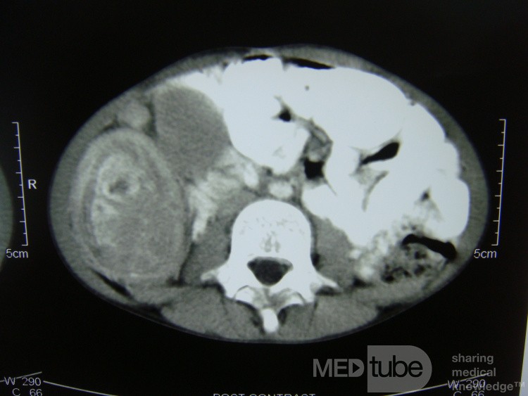 Une invagination intestinale.