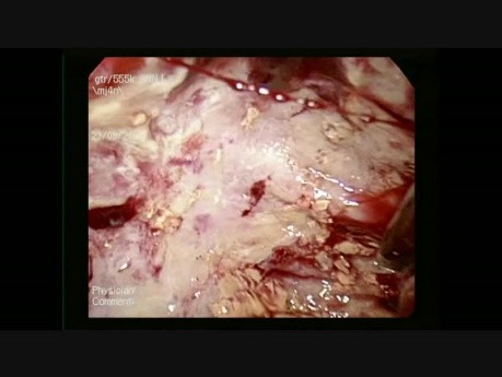 Traitement laparoscopique d'un kyste hydatique du foie