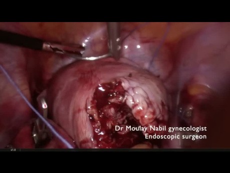 Astuces pour la Myomectomie Laparoscopique