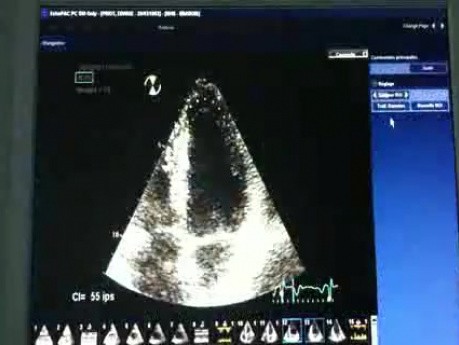 L'évaluation de la fonction systolique ventriculaire gauche - Le 2D strain