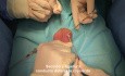 Vasectomie Sans Scalpel (Réversible)