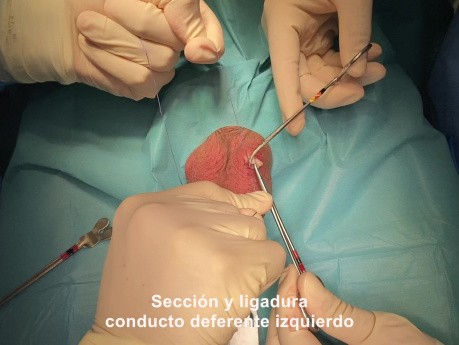 Vasectomie Sans Scalpel (Réversible)