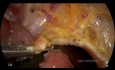 TAMİS - Chirurgie mini-invasive transanale pour les polypes rectaux malins T1