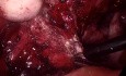 Volumineuse Endométriose Pelvienne et Caecale 