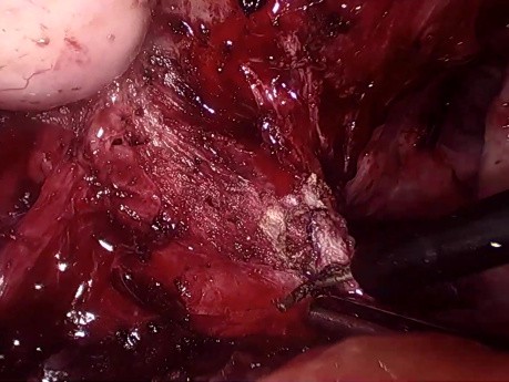 Volumineuse Endométriose Pelvienne et Caecale 