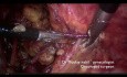 Hystérectomie Totale C1 pour un Cas Rare d'Adénocarcinome Endocervical NOS