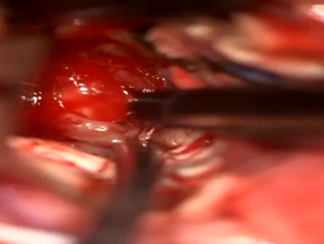 Craniotomie Occipitale Gauche et Résection d'une Lésion Thalamique