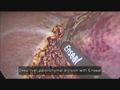  Ablation du lobe gauche du foie par voie laparascopique