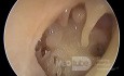 Perforation Totale du Tympan