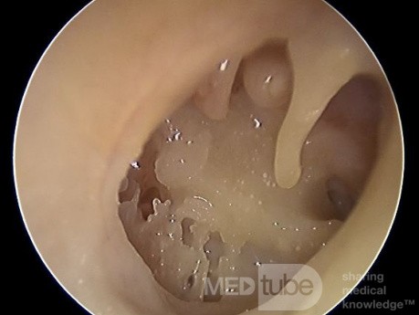 Perforation Totale du Tympan