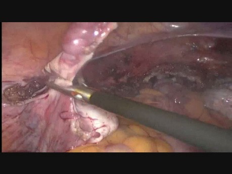 Hystérectomie totale par voie laparoscopique en 24 semaines pour un fibrome utérin de grande taille