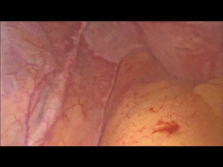 Myomectomie pour Fibrome du Ligament Large