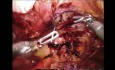 Réparation Prépéritonéale Robotique d'une Hernie de Spiegel de Grande Taille dans un Contexte d'Anévrisme de l'Aorte Abdominale 