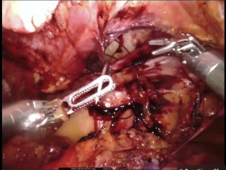 Réparation Prépéritonéale Robotique d'une Hernie de Spiegel de Grande Taille dans un Contexte d'Anévrisme de l'Aorte Abdominale 