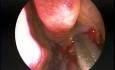 Hypoplasie du sinus maxillaire de type 2 - Prise en charge endoscopique