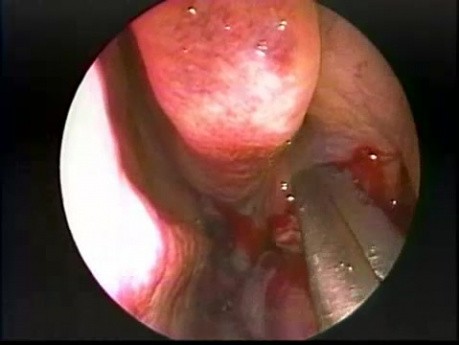 Hypoplasie du sinus maxillaire de type 2 - Prise en charge endoscopique