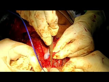 Pose d'une Prothèse Trachéo-Oesophagienne (PTO) après Laryngectomie