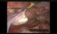 Ablation des nodules situés dans la cloison recto-vaginale avec l'hystérectomie laparoscopique totale