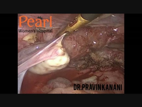 Ablation des nodules situés dans la cloison recto-vaginale avec l'hystérectomie laparoscopique totale