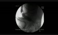 Coloscopie - Prise en charge endoscopique d'une Occlusion du Côlon - Dilatation de la Sténose
