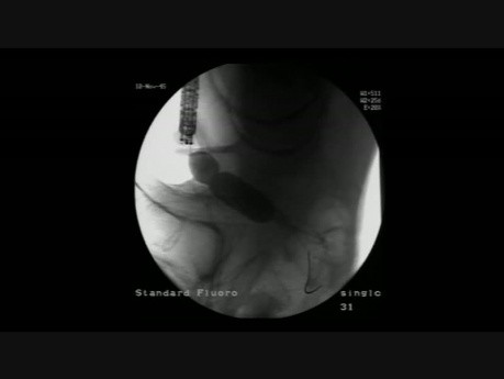 Coloscopie - Prise en charge endoscopique d'une Occlusion du Côlon - Dilatation de la Sténose