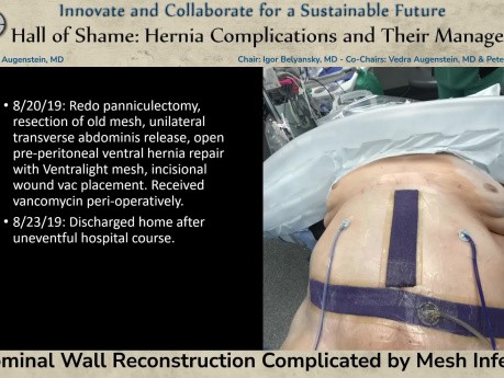 Abdominoplastie Compliquée par une Infection du Filet