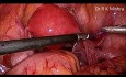 Oophoropexie par laparoscopie