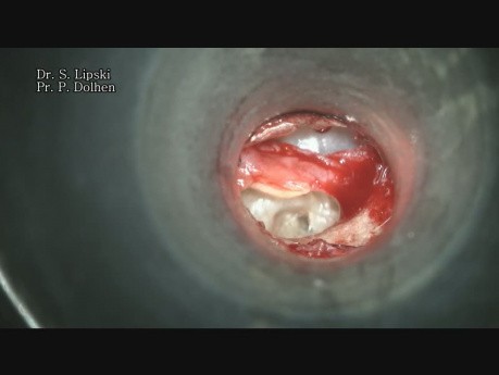 Révision chirurgicale d'une prothèse ossiculaire de type TORP inefficace dans l'oreille droite