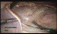 Fibrome du ligament large de 18 cm, qui s'étend à l'isthme