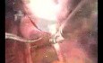 Hystérectomie laparoscopique totale avec annexectomie bilatérale