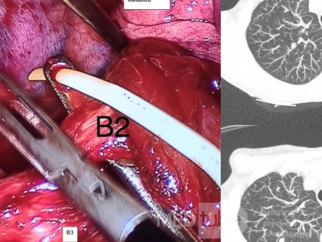 Segmentectomie Droite S2 VATS (Vidéo-Assistée)