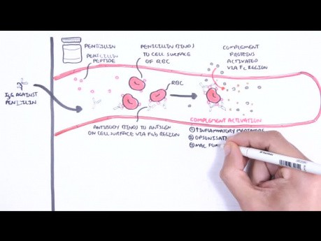 Hypersensibilité de type II (réaction cytotoxique) - causes, physiopathologie, système complémentaire