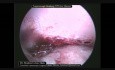 Drainage laparoscopique de l'abcès hépatique