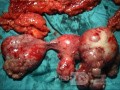 Cancer de l'ovaire - une chirurgie radicale