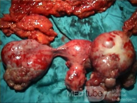 Cancer de l'ovaire - une chirurgie radicale
