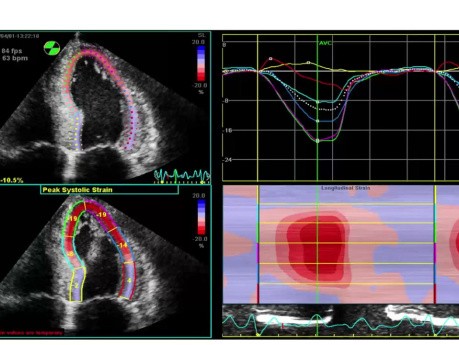 Caractéristiques Echocardiographiques des Maladies de Système - Une Discussion Basée sur des Cas