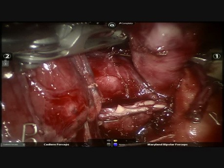 Adénocarcinome pulmonaire - Lobectomie moyenne robot-assistée après un traitement néoadjuvant