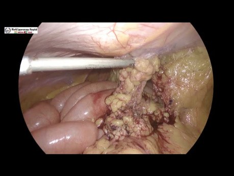 Réparation laparoscopique d'une hernie ombilicale récurrente