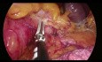  Exérèse totale du mésorectum (ETM) - Mobilisation de l'angle colique gauche de côté médiale à latérale.