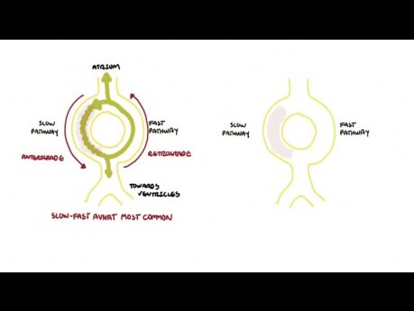 Tachycardie par réentrée intranodale  - TRIN - causes, physiopathologie, prise en charge